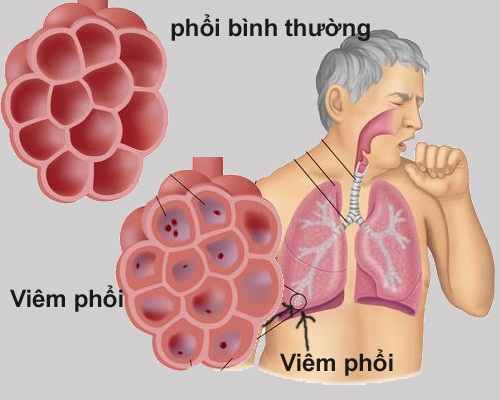 triệu chứng viêm phổi cấp